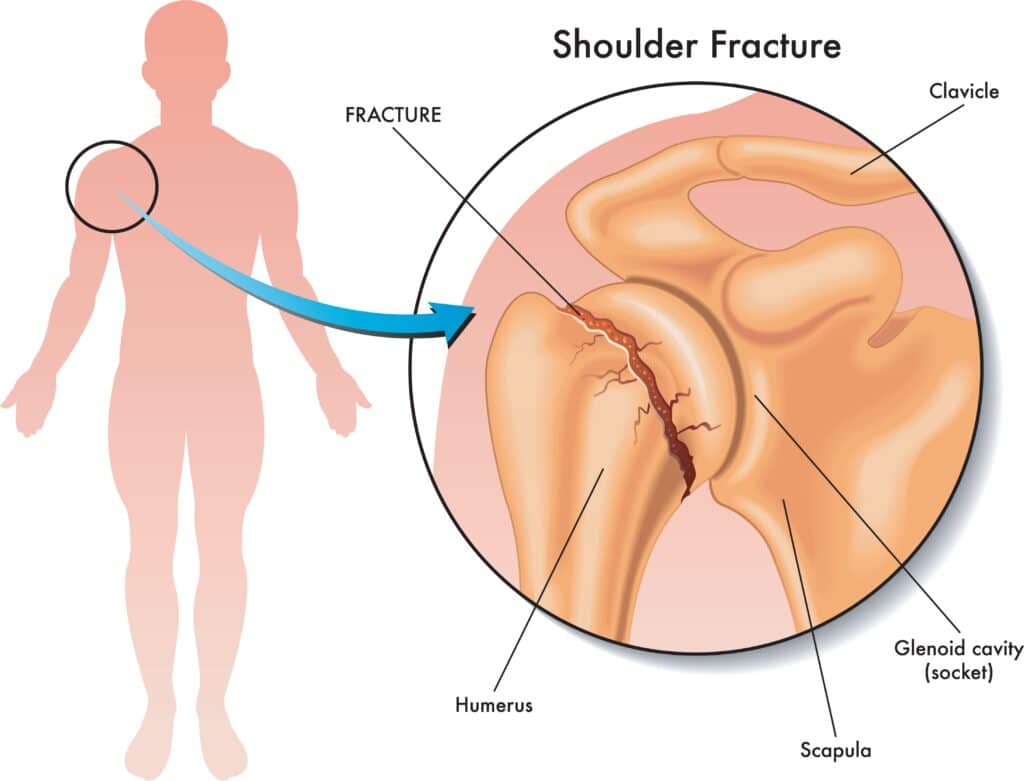 shoulder fractures singapore