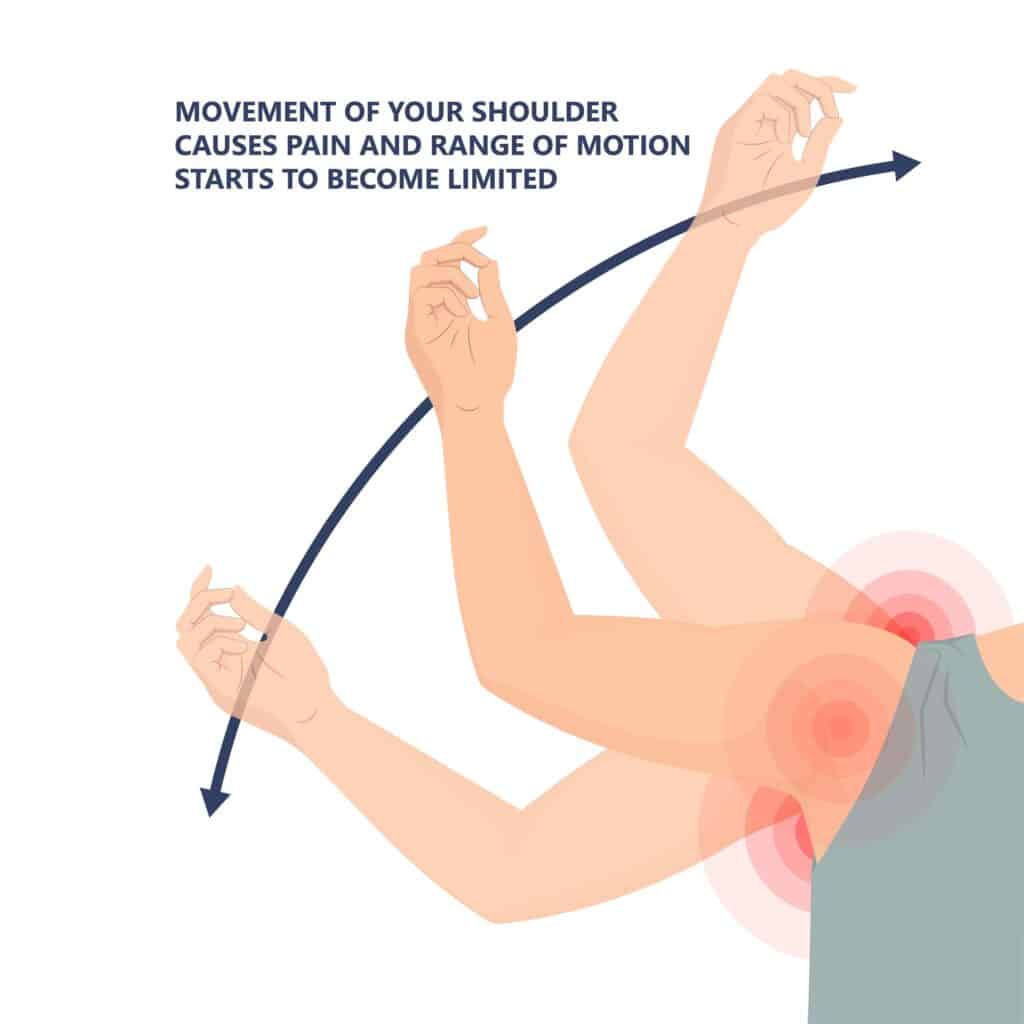 symptoms of shoulder fractures