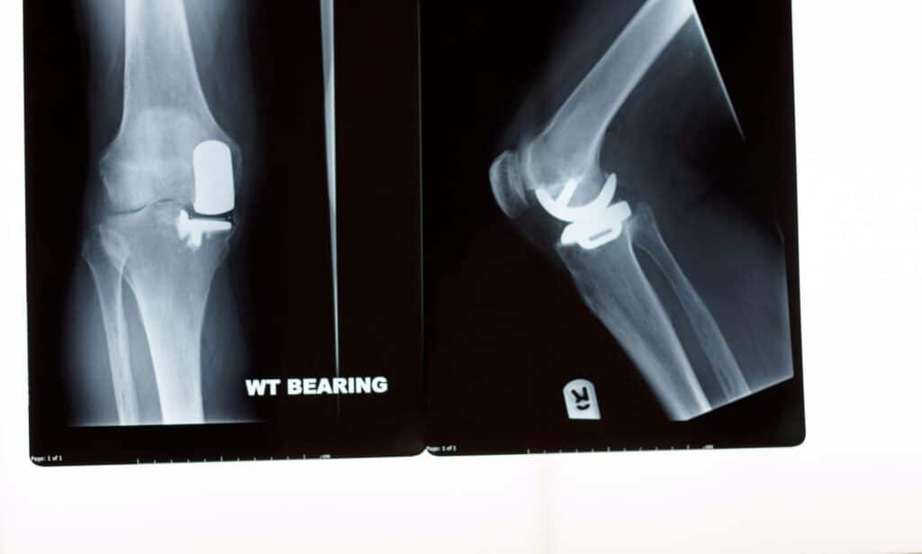 partial knee replacement surgery